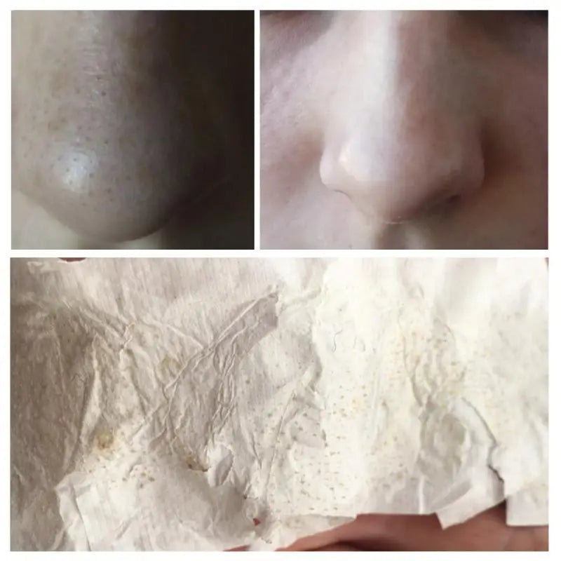 LANBENA's Suction Blackhead Remover